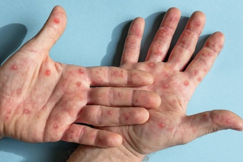 Mpox: saiba quais são os sintomas, como ocorre a transmissão e quais os tratamentos